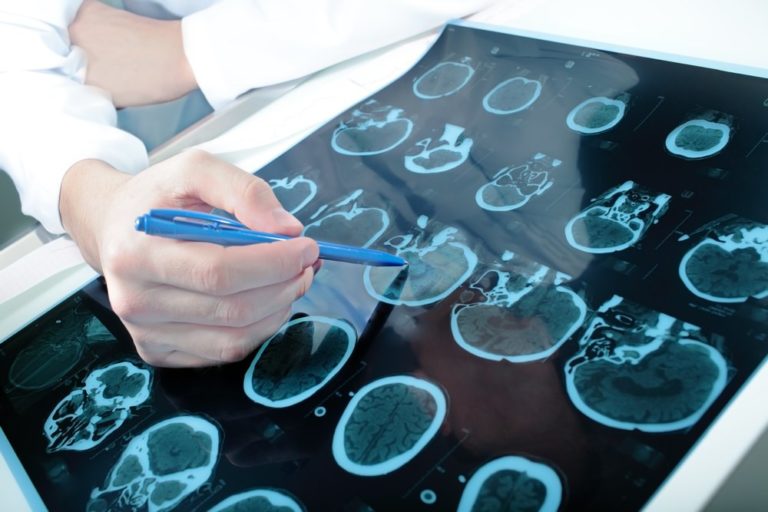 New Study Aims to Discover the Connection Between Alzheimer’s Disease and Inuslin